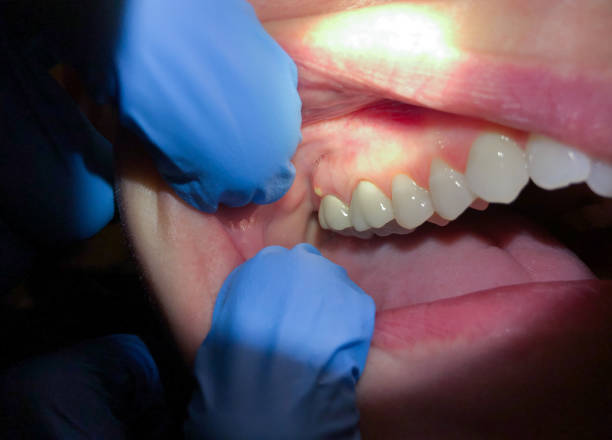 Best Emergency Care for Gum Disease in Branson, MO